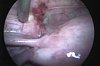 Endometriózis laparoszkópos műtéti képe. Forrás: dr. Pusztai Zoltán weboldala